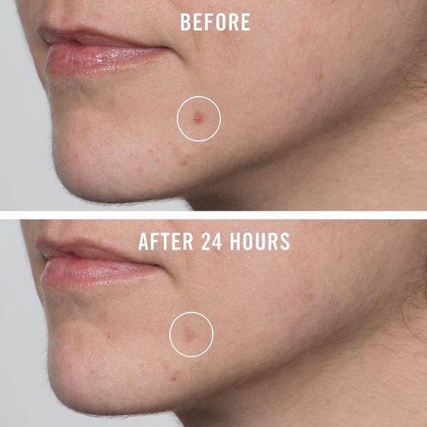 First Aid Beauty FAB Pharma BHA Acne Spot Treatment #5